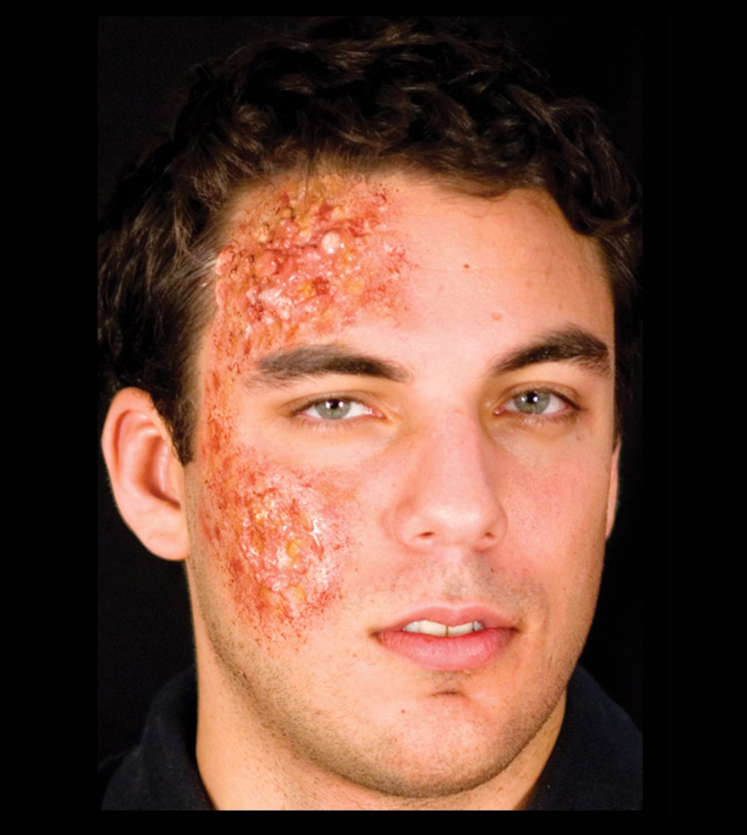 Woochie - Infected appliance injury